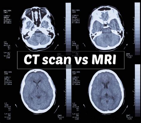 In my experience, all MRI results are discussed in person at an appointment, so waiting to discuss in person tells you nothing one way or the other, it&39;s just standard procedure. . If mri results are bad do they tell you right away reddit